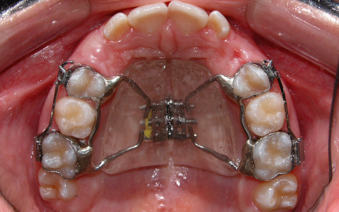 Experiência com expansor das arcadas – Ortodontia Preventiva
