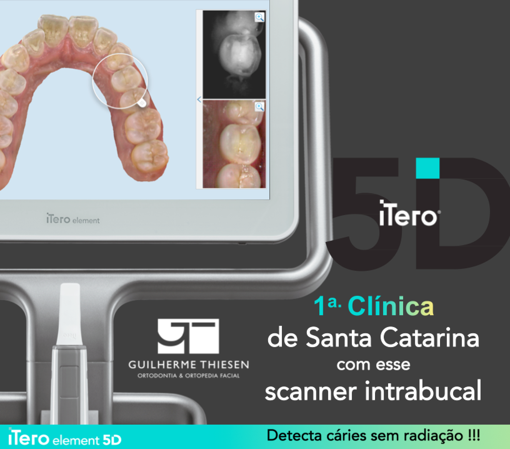 Scanner iTero5D – Detecta cárie sem radiação