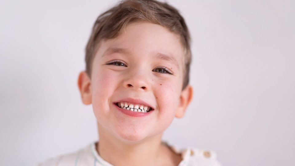 Fluorose Dentária: entenda as causas dessas manchas nos dentes