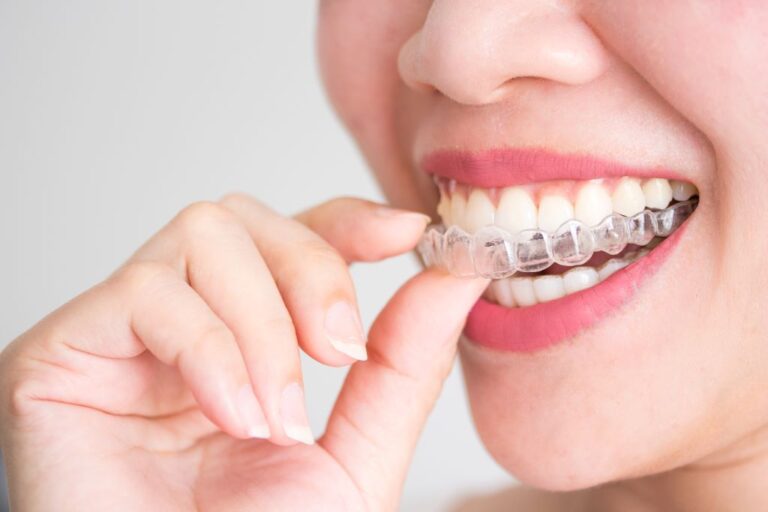 Quanto custa Invisalign? Conheça os valores e tipos do aparelho invisível!